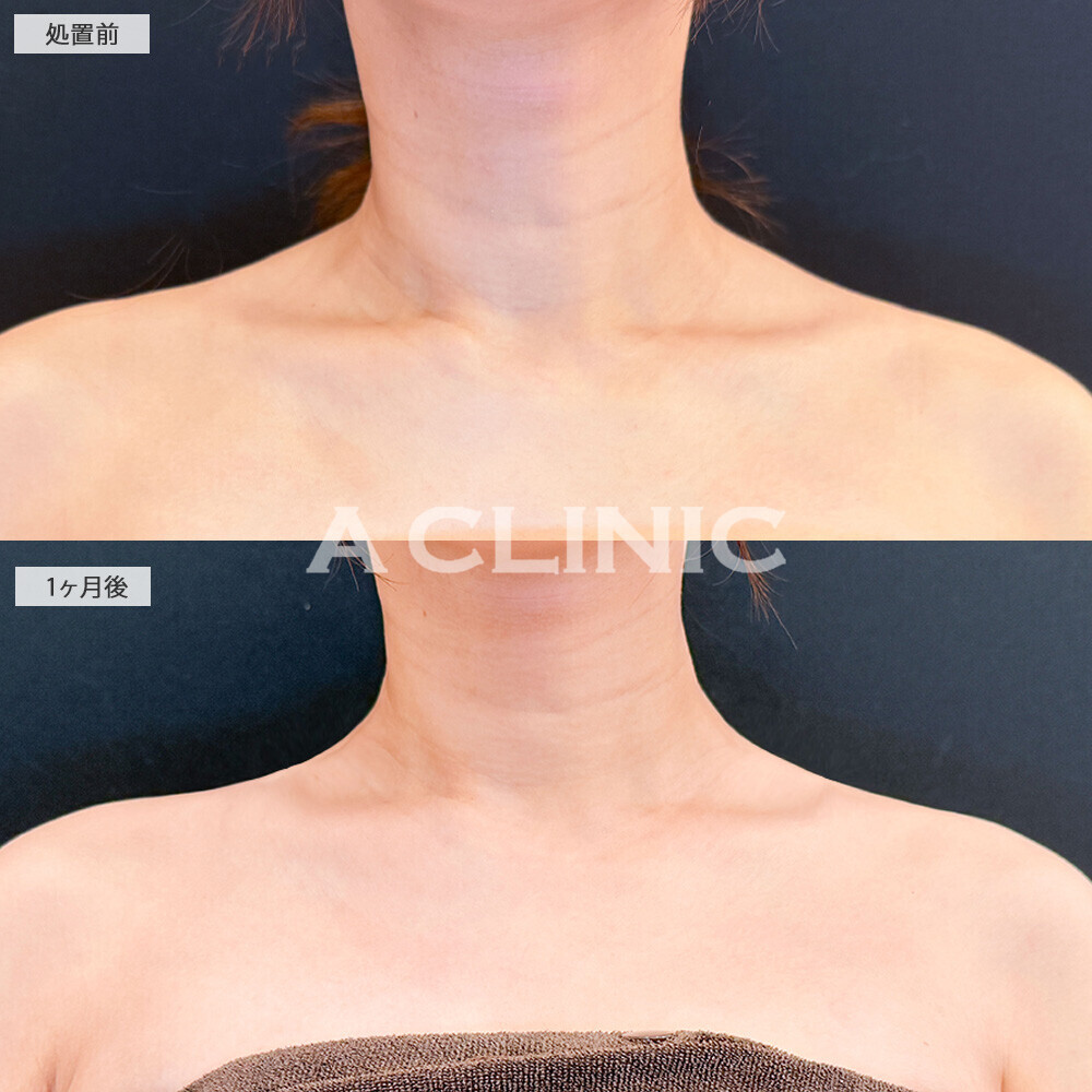 ボトックス注射(肩)で肩こりも改善し見た目もスッキリ！こちら処置前と１ヶ月後の症例です(20代女性)