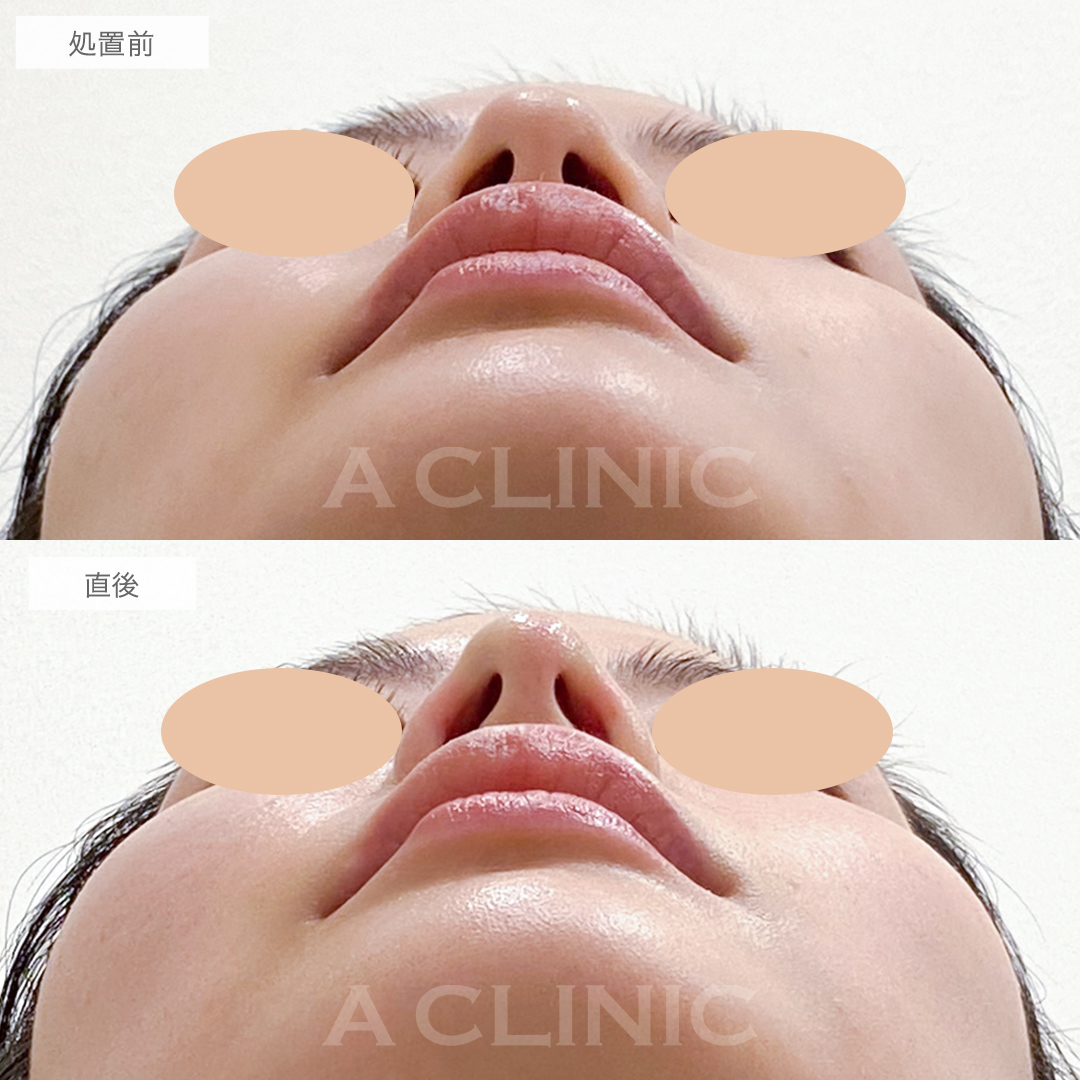 コリアンノーズでお鼻の垢抜けが叶います！処置前と直後の症例です(30代女性)