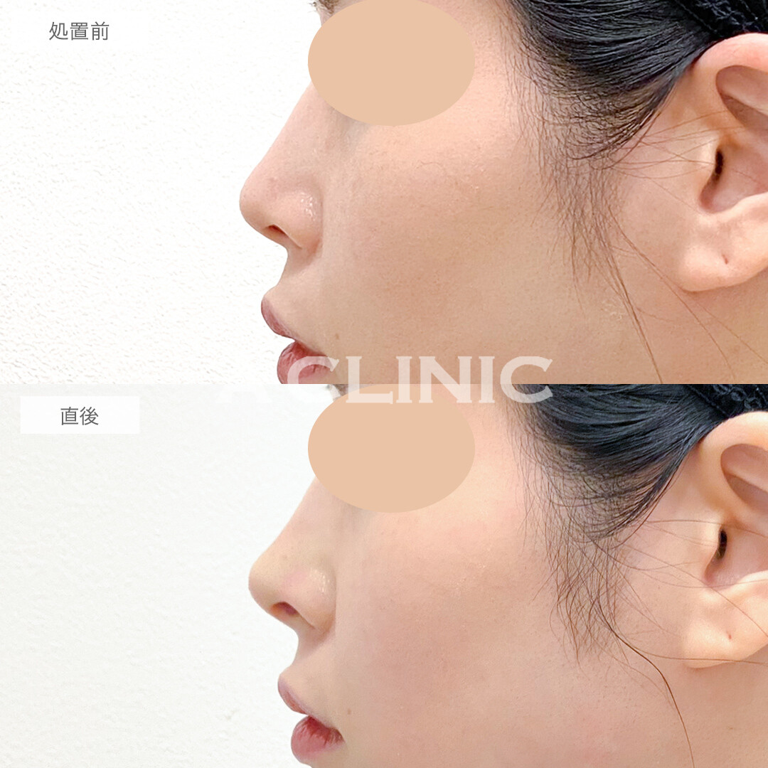 コリアンノーズでお鼻の垢抜けが叶います！処置前と直後の症例です(30代女性)