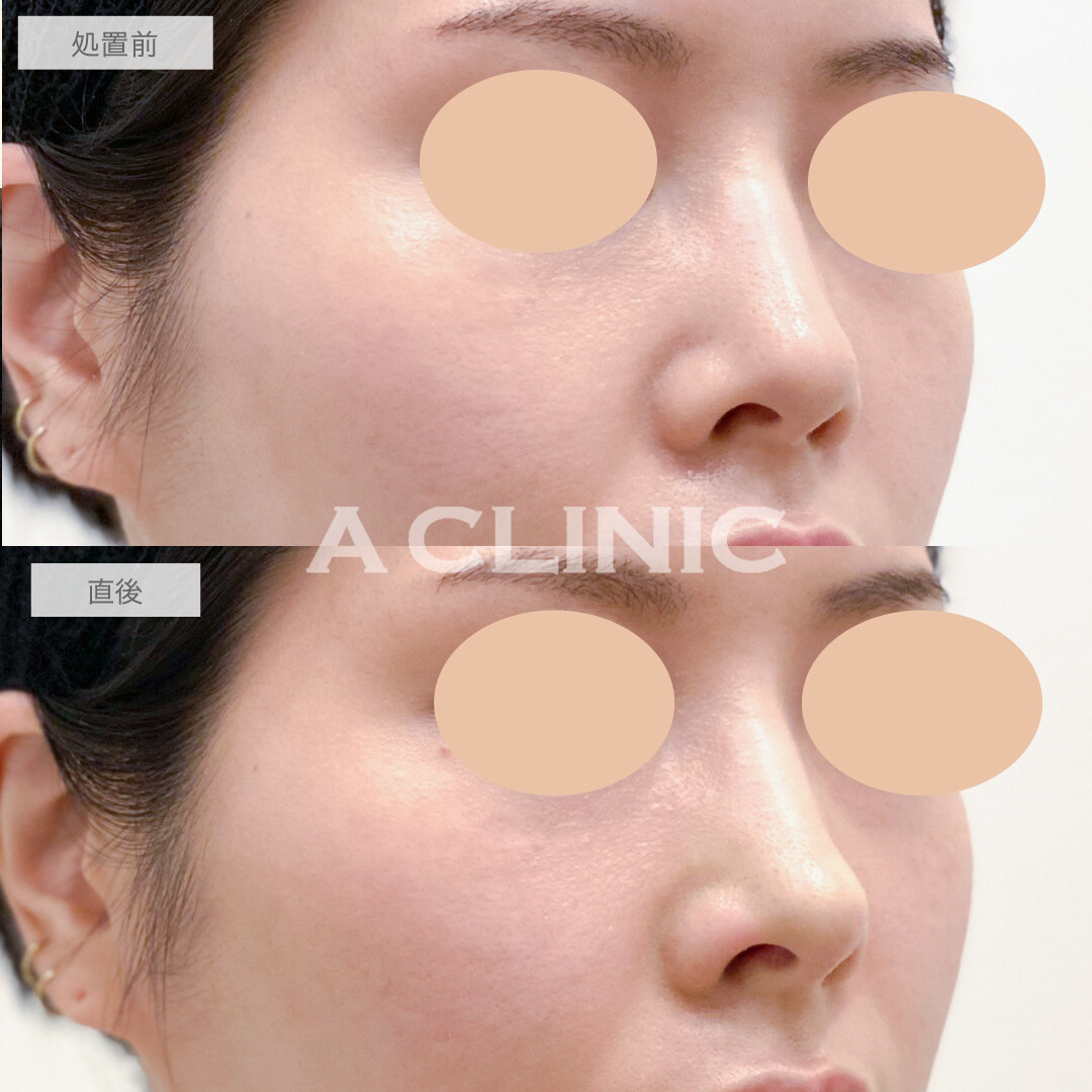 コリアンノーズでお鼻の垢抜けが叶います！処置前と直後の症例です(30代女性)
