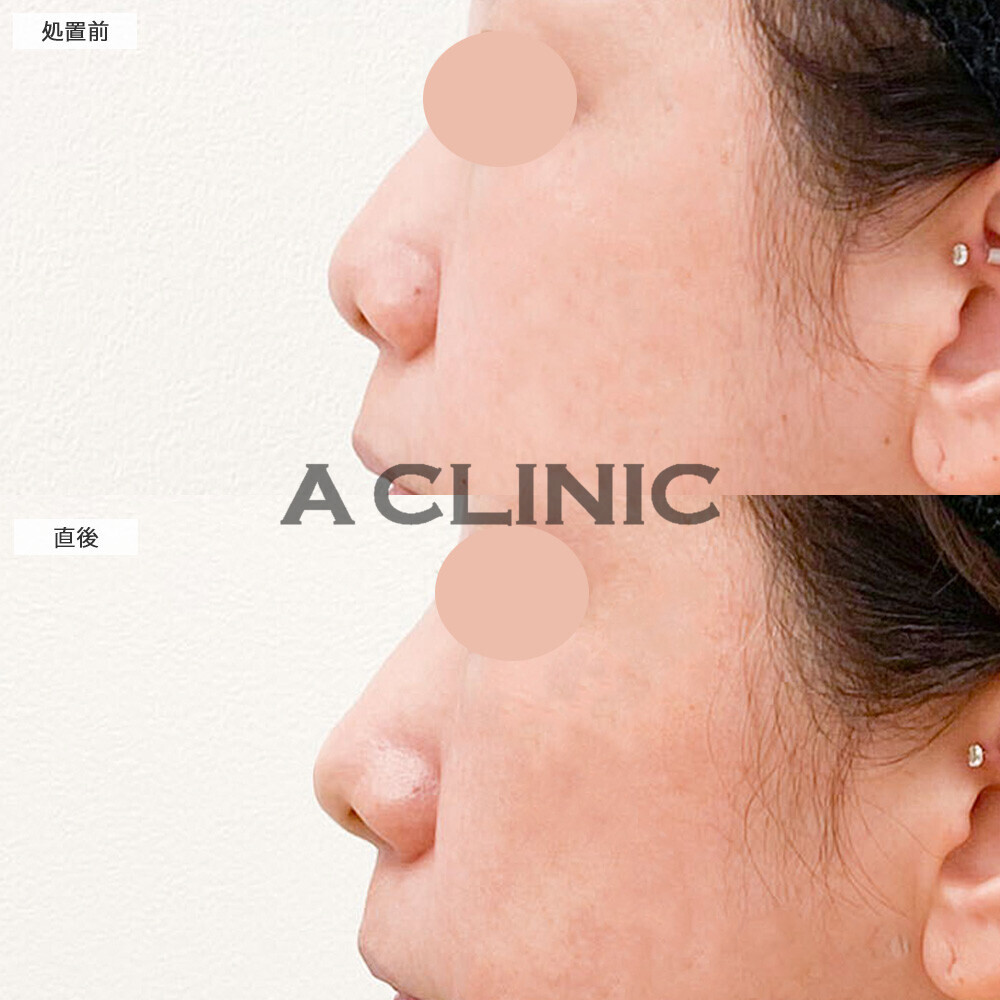 コリアンノーズで整形感なくナチュラルながらもしっかり垢抜け！こちら処置前と直後の症例です(40代女性)