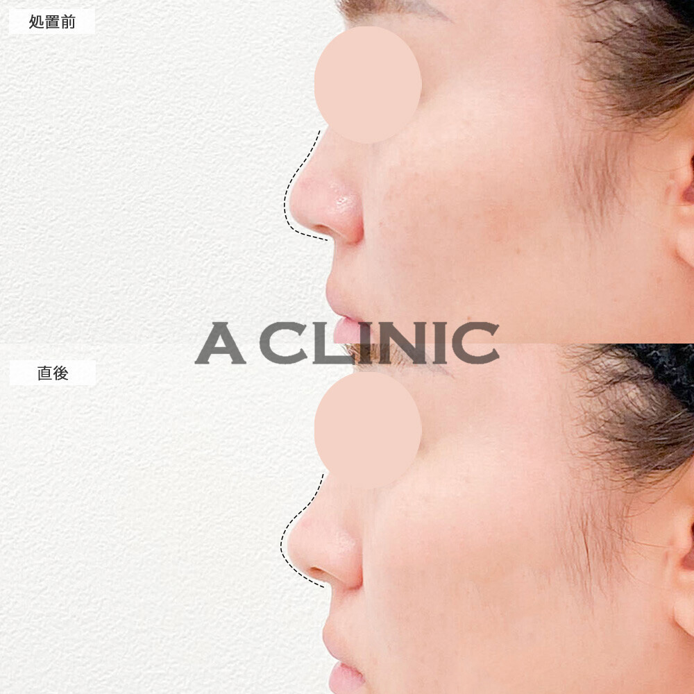 コリアンノーズなら注射のみでナチュラルに垢抜け！こちら処置前と直後の症例です(20代女性)