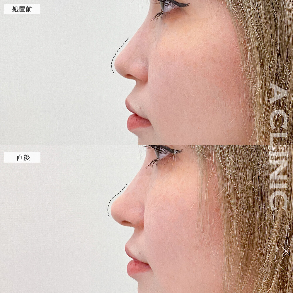 コリアンノーズでより立体的な横顔に！こちら処置前と直後の症例です(20代女性)