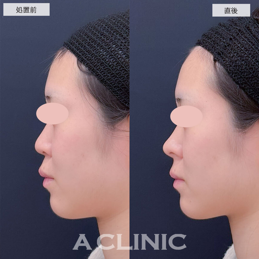 コリアンノーズで直後から韓国アイドルのような自然なアップノーズになりました！こちら処置前と直後の症例です(10代女性)