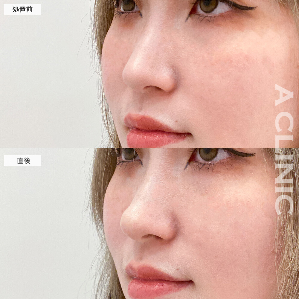 コリアンノーズでより立体的な横顔に！こちら処置前と直後の症例です(20代女性)