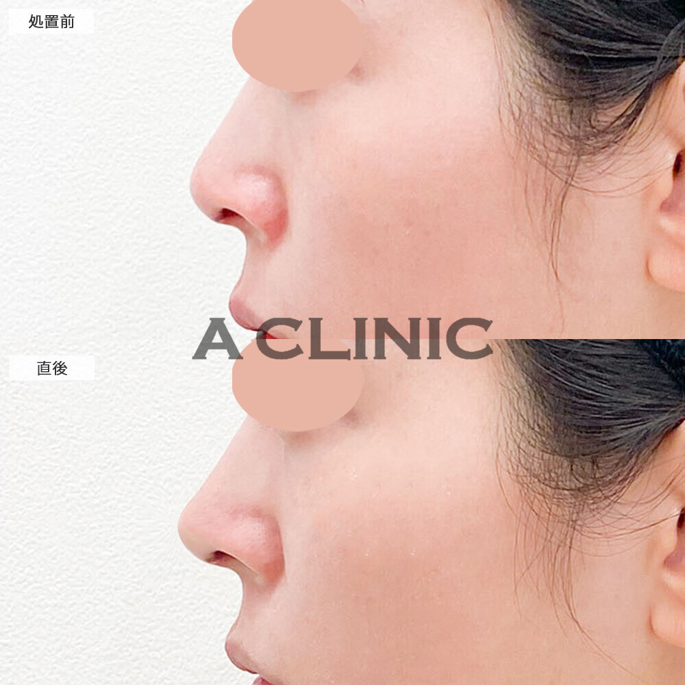 コリアンノーズで整形感なく鼻先がツンとなりました！こちら処置前と直後の症例です(30代女性)