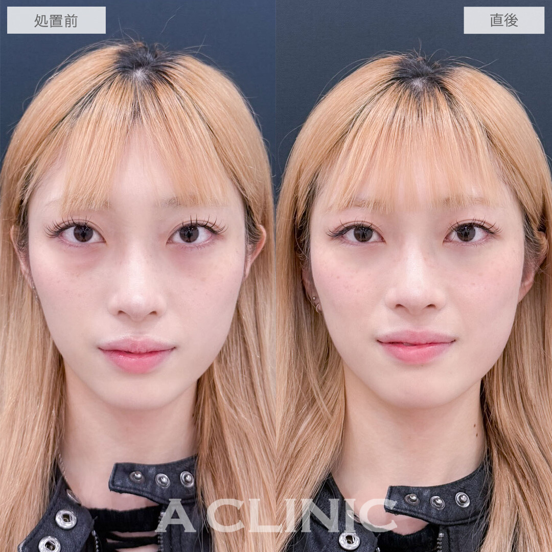 目の下のクマ取りでクマを無くして欠点の無い目元に！こちら処置前と直後の症例です(20代女性)