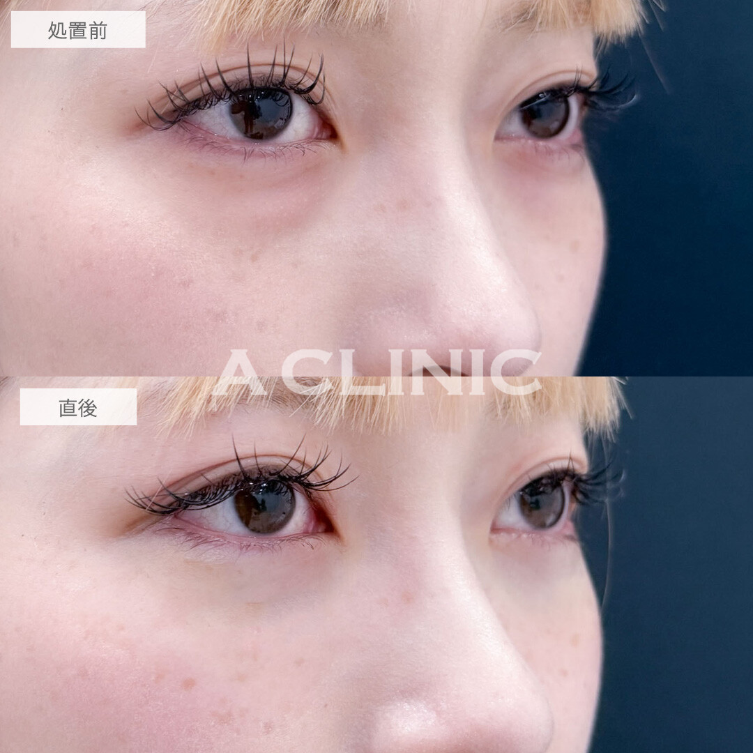 目の下のクマ取りでクマを無くして欠点の無い目元に！こちら処置前と直後の症例です(20代女性)