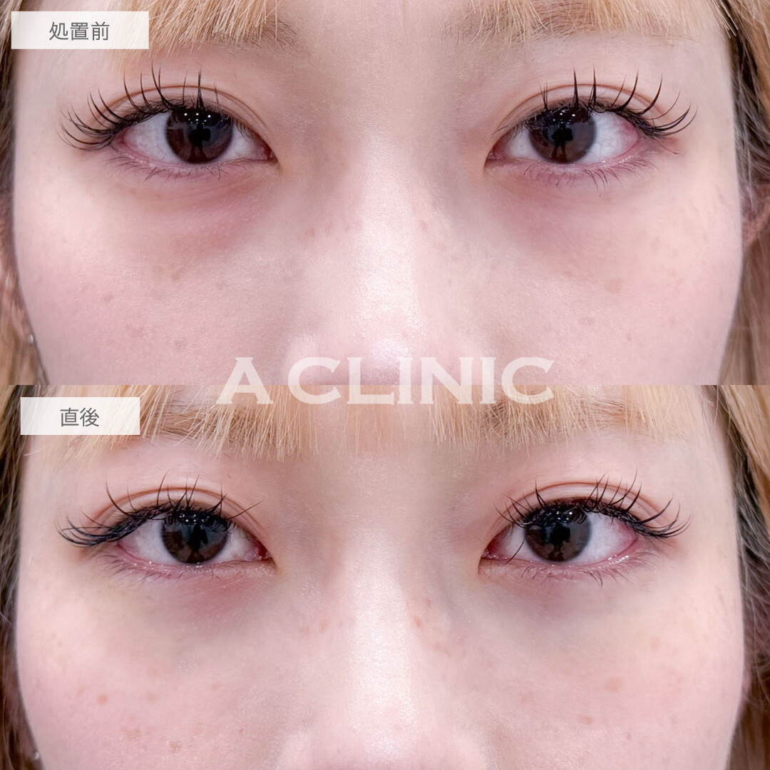 目の下のクマ取りでクマを無くして欠点の無い目元に！こちら処置前と直後の症例です(20代女性)