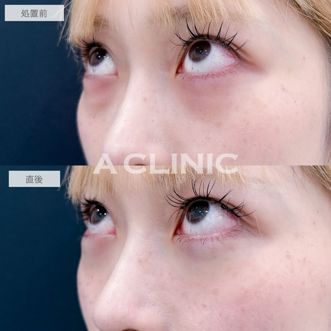 目の下のクマ取りでクマを無くして欠点の無い目元に！こちら処置前と直後の症例です(20代女性)