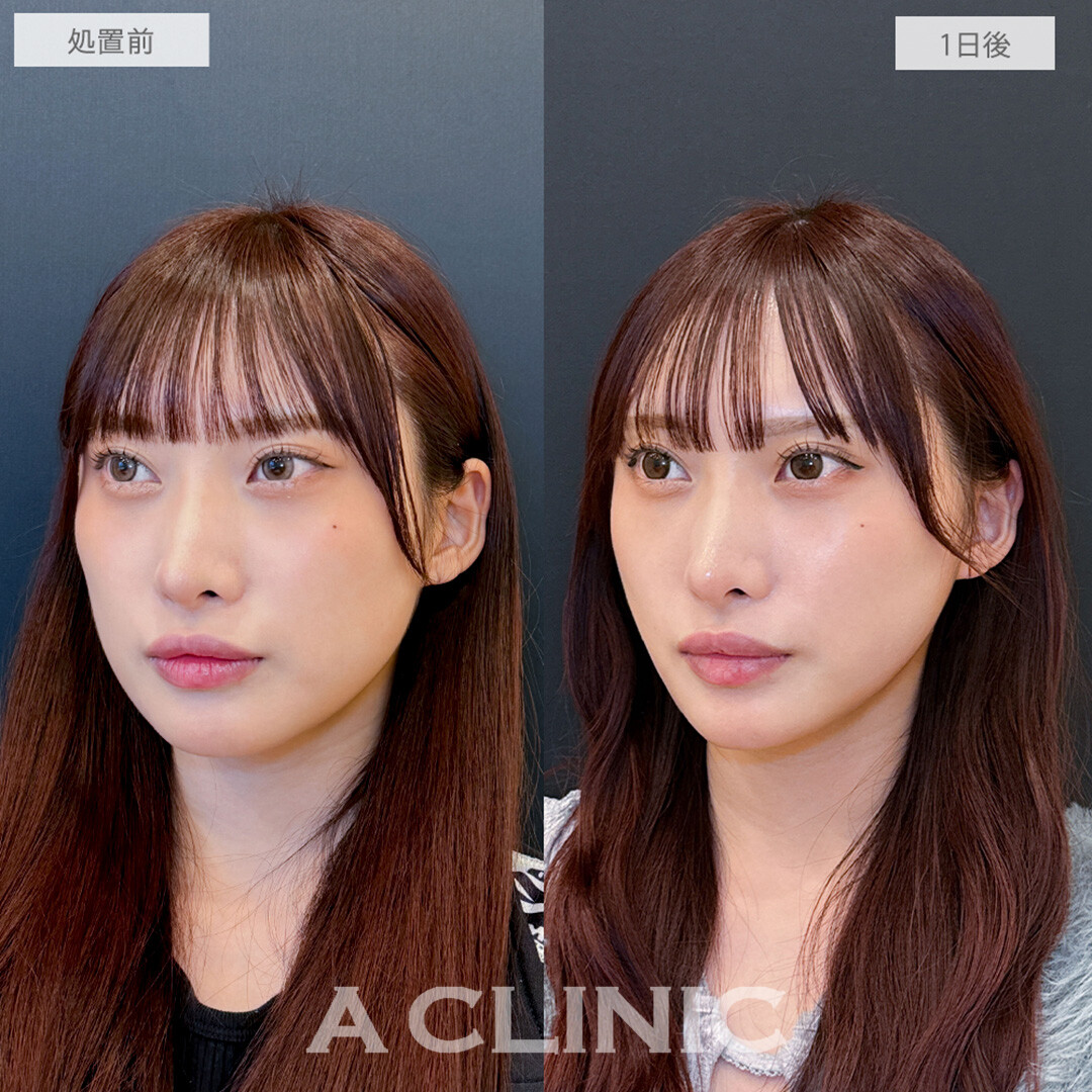 1day小顔脂肪吸引でフェイスラインが整いワンランク上の小顔に！処置前と1日後の症例です(20代女性)