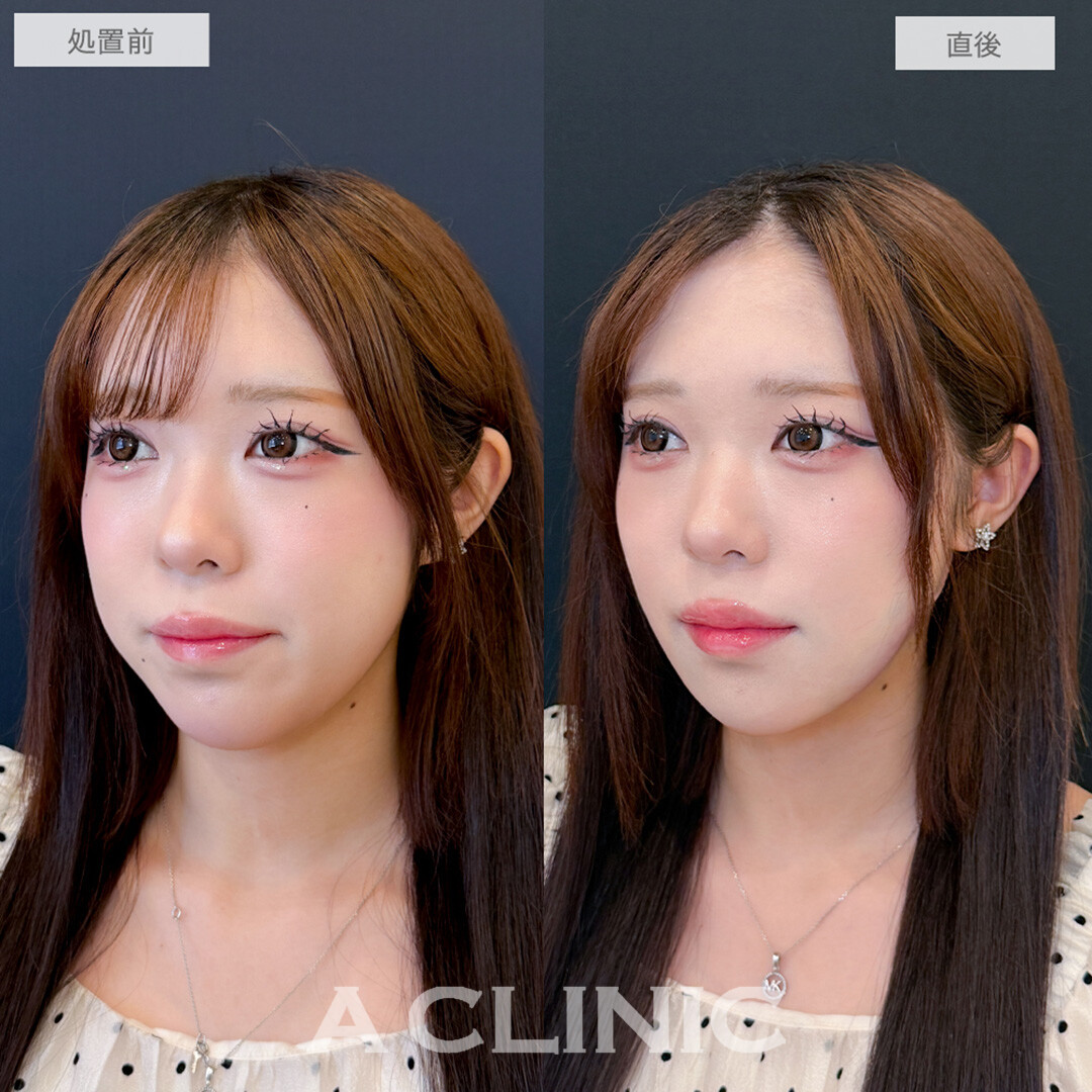 1day小顔脂肪吸引で骨切りいらずの大変化！処置前と直後の症例です(10代女性)