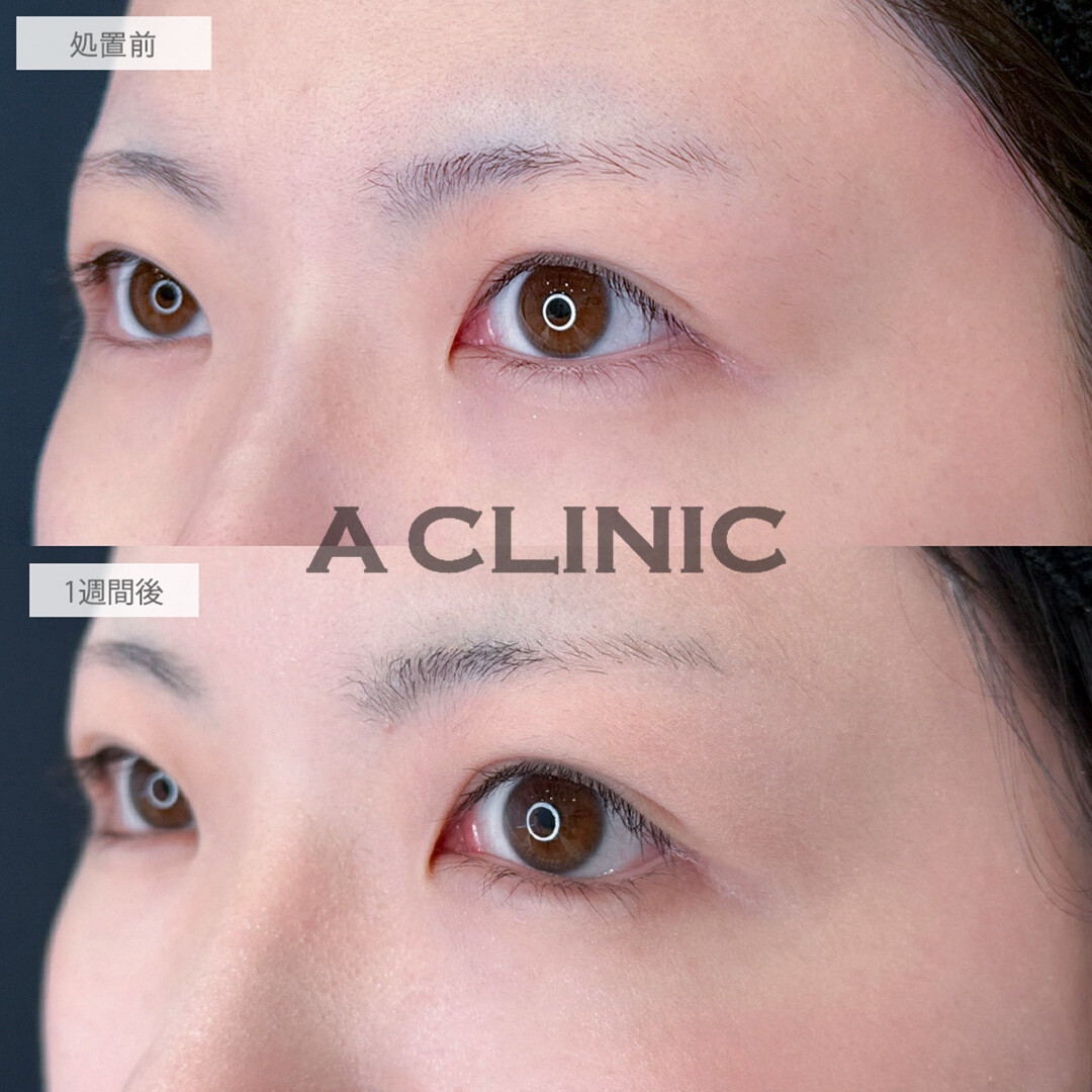 パーフェクトアイズでナチュラルに存在感のあるお目元に！処置前と1週間後の症例です(20代女性)