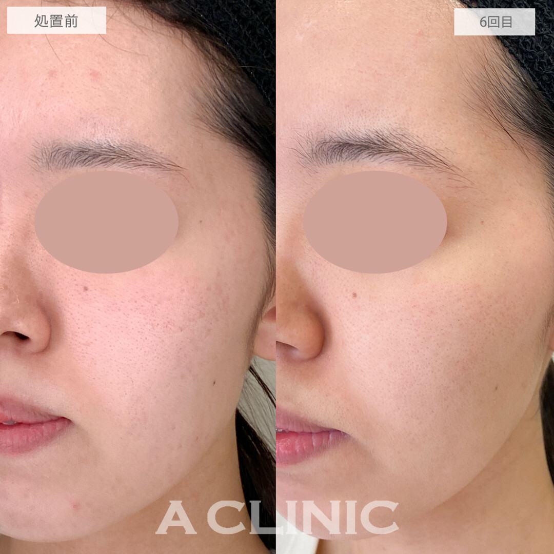 ポテンツァでニキビ跡と頑固なクレーターを撃退！処置前と6回目の症例です(20代女性)