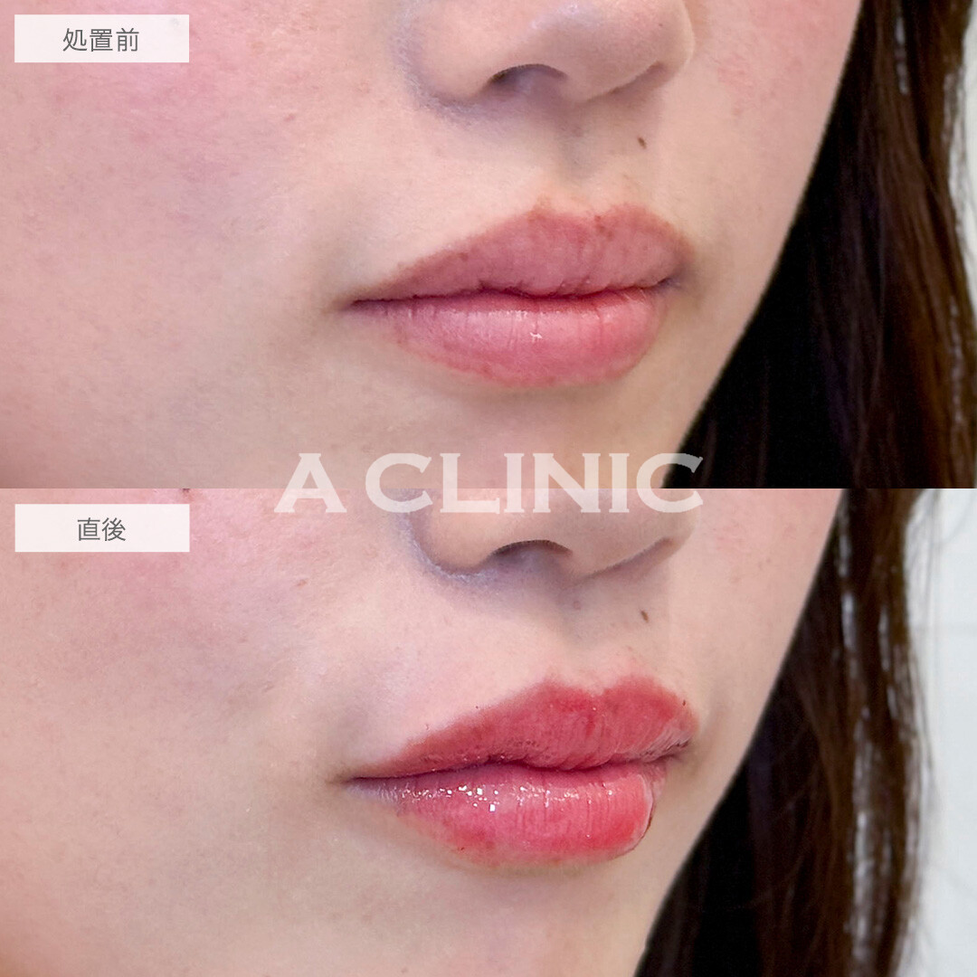 スマイルリップで自然にボリュームアップして可愛い唇に！処置前と直後の症例です(20代女性)