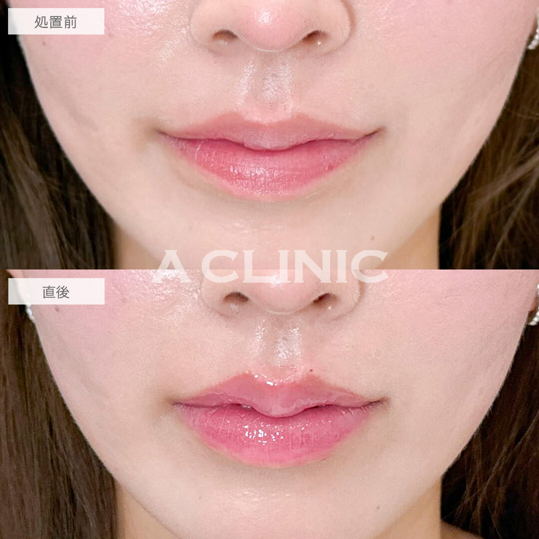 スマイルリップで華やかな印象に！処置前と直後の症例です(20代女性)