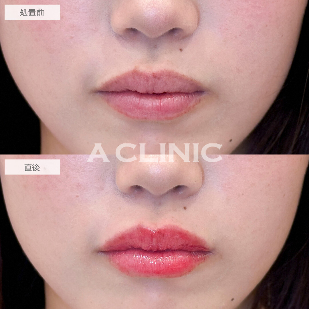 スマイルリップで自然にボリュームアップして可愛い唇に！処置前と直後の症例です(20代女性)