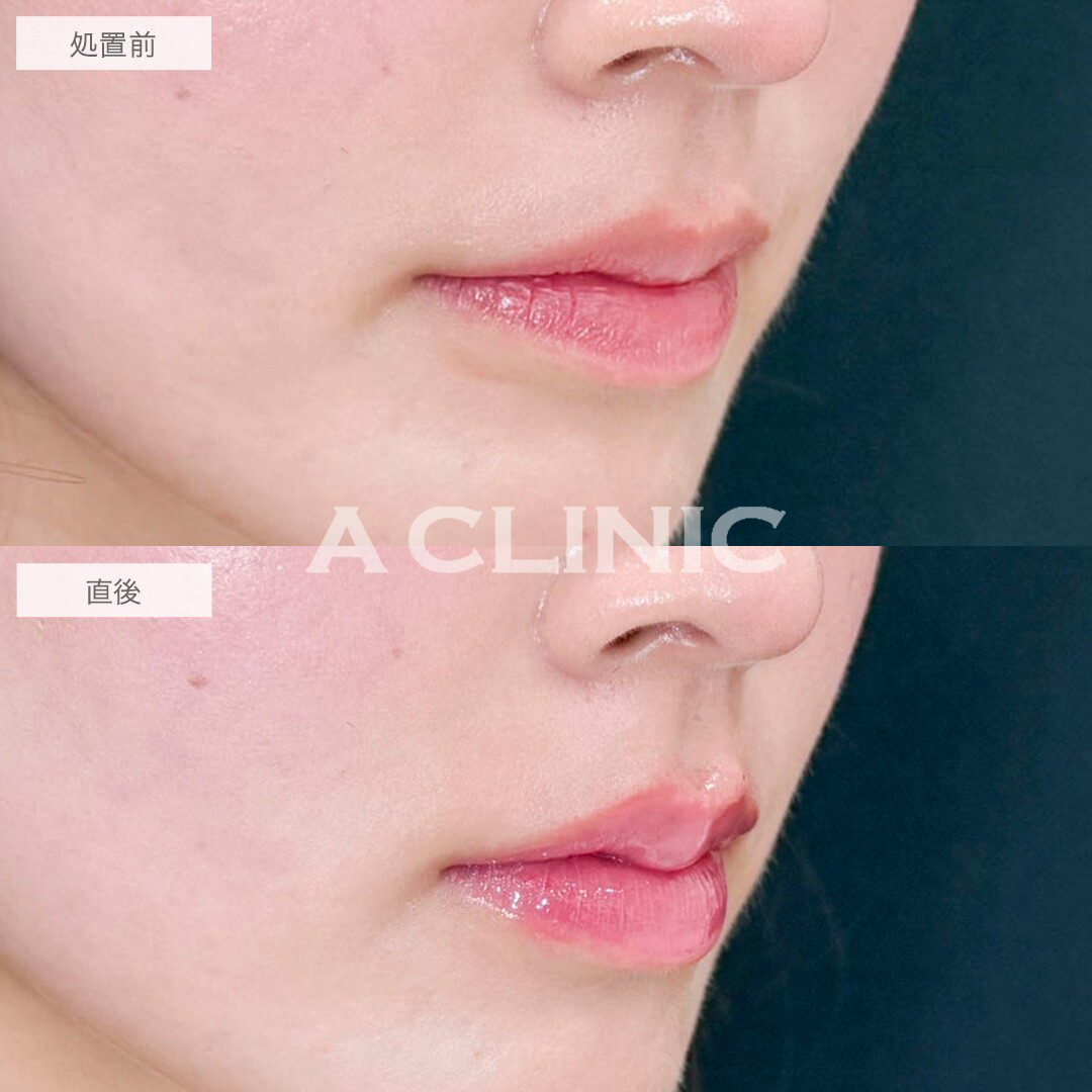 スマイルリップで華やかな印象に！処置前と直後の症例です(20代女性)