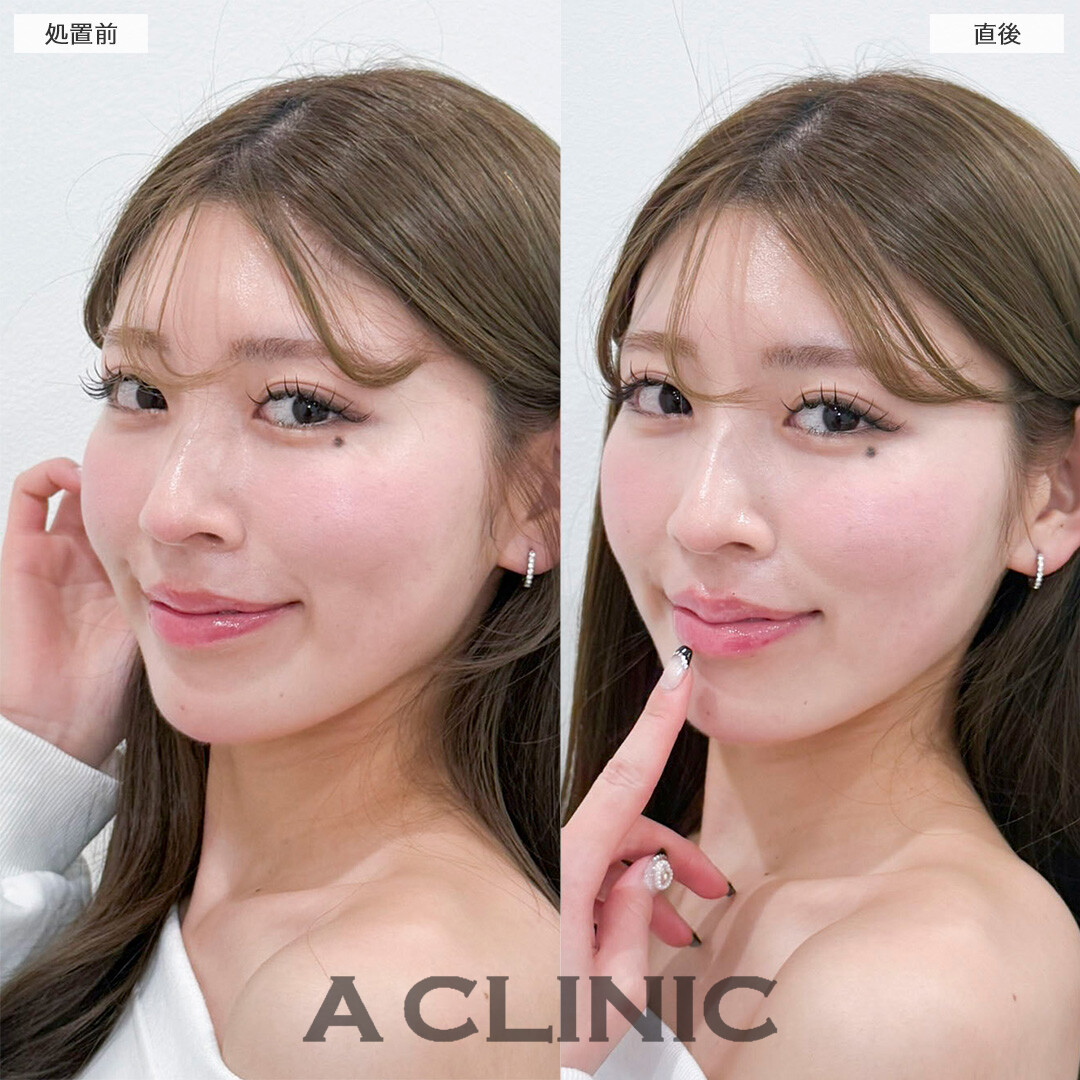 スマイルリップで華やかな印象に！処置前と直後の症例です(20代女性)