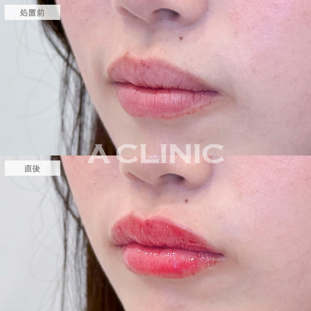 スマイルリップで自然にボリュームアップして可愛い唇に！処置前と直後の症例です(20代女性)