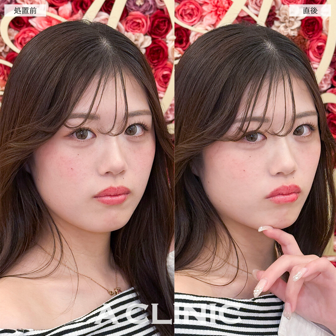 スマイルリップで自然にボリュームアップして可愛い唇に！処置前と直後の症例です(20代女性)