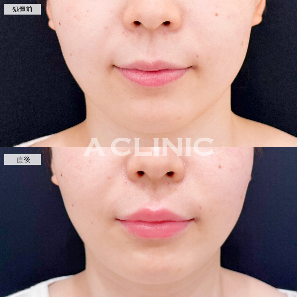 リップヒアルロン酸注入で綺麗なM字リップが爆誕！こちら処置前と直後の症例です(20代女性)
