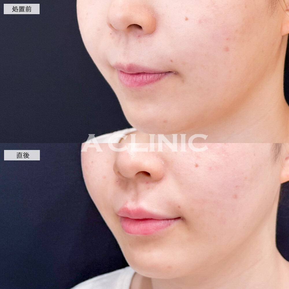 リップヒアルロン酸注入で綺麗なM字リップが爆誕！こちら処置前と直後の症例です(20代女性)