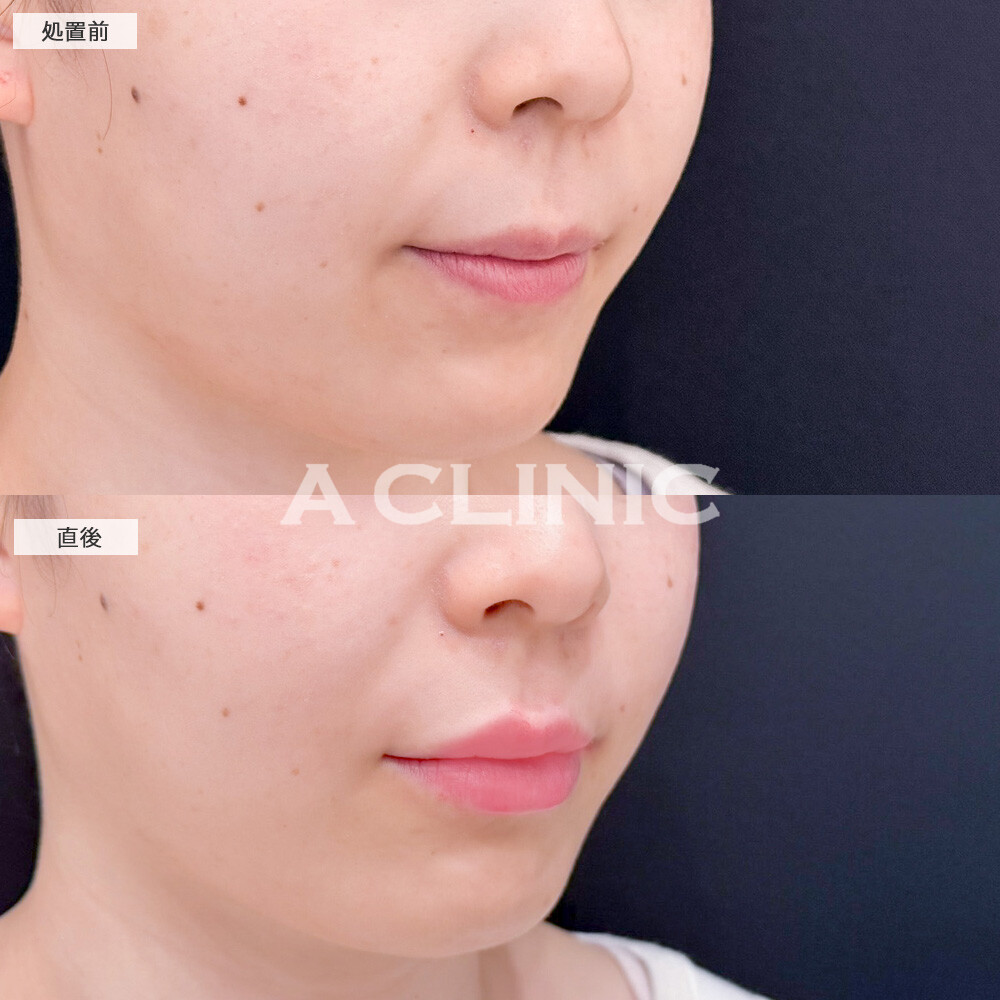 リップヒアルロン酸注入で綺麗なM字リップが爆誕！こちら処置前と直後の症例です(20代女性)