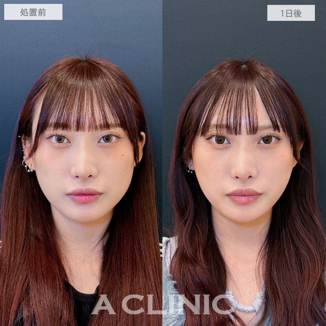 1day小顔脂肪吸引でフェイスラインが整いワンランク上の小顔に！処置前と1日後の症例です(20代女性)