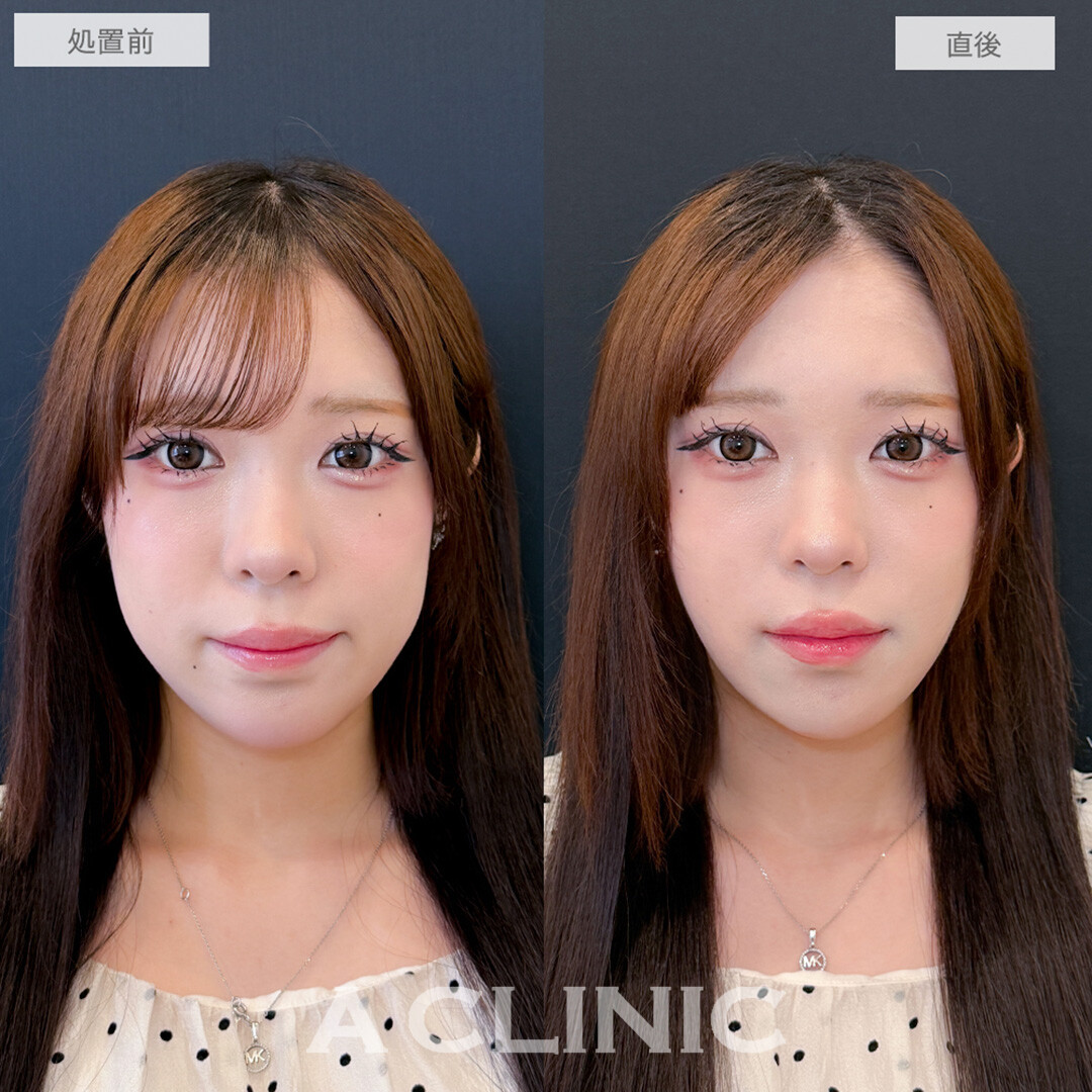 1day小顔脂肪吸引で骨切りいらずの大変化！処置前と直後の症例です(10代女性)