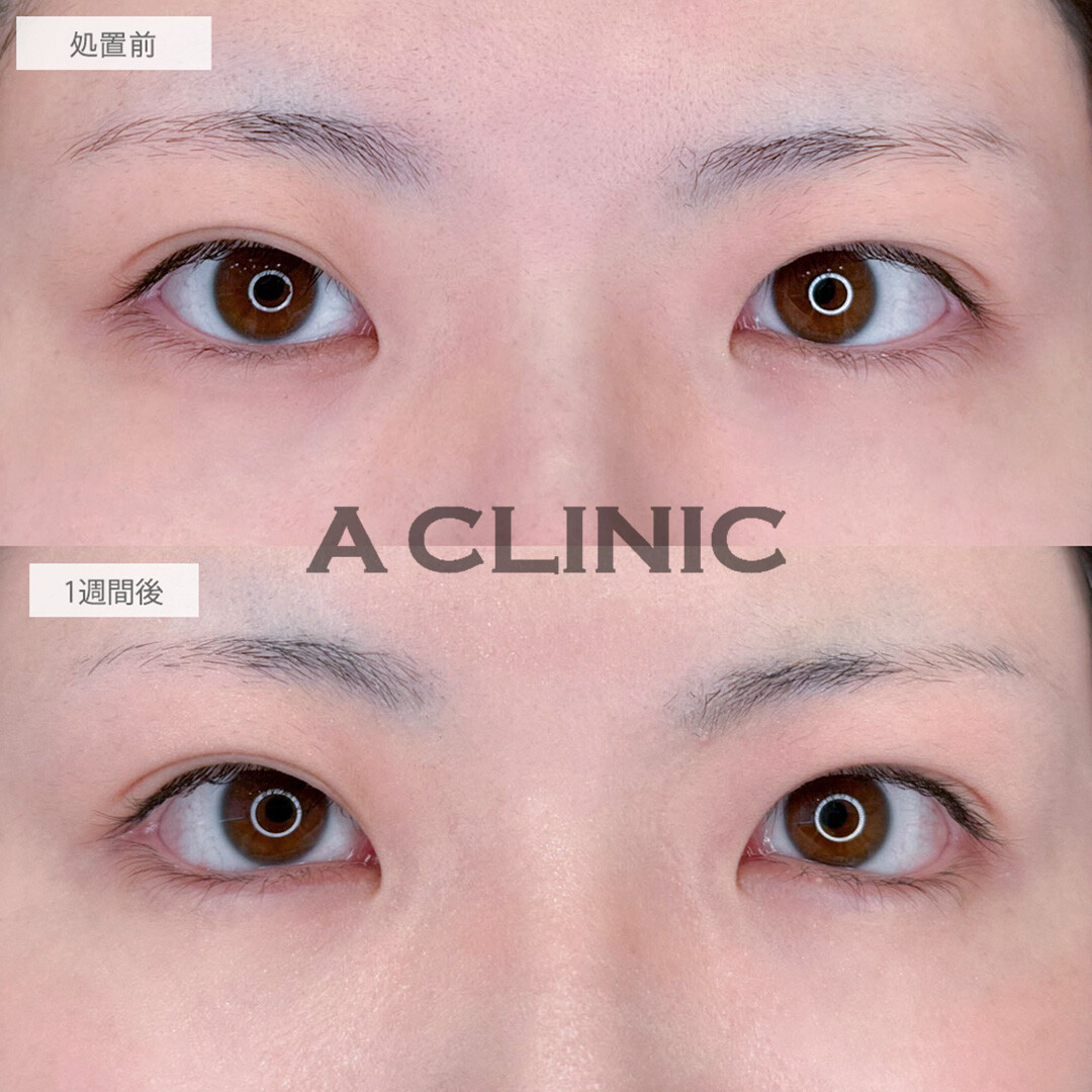 パーフェクトアイズでナチュラルに存在感のあるお目元に！処置前と1週間後の症例です(20代女性)