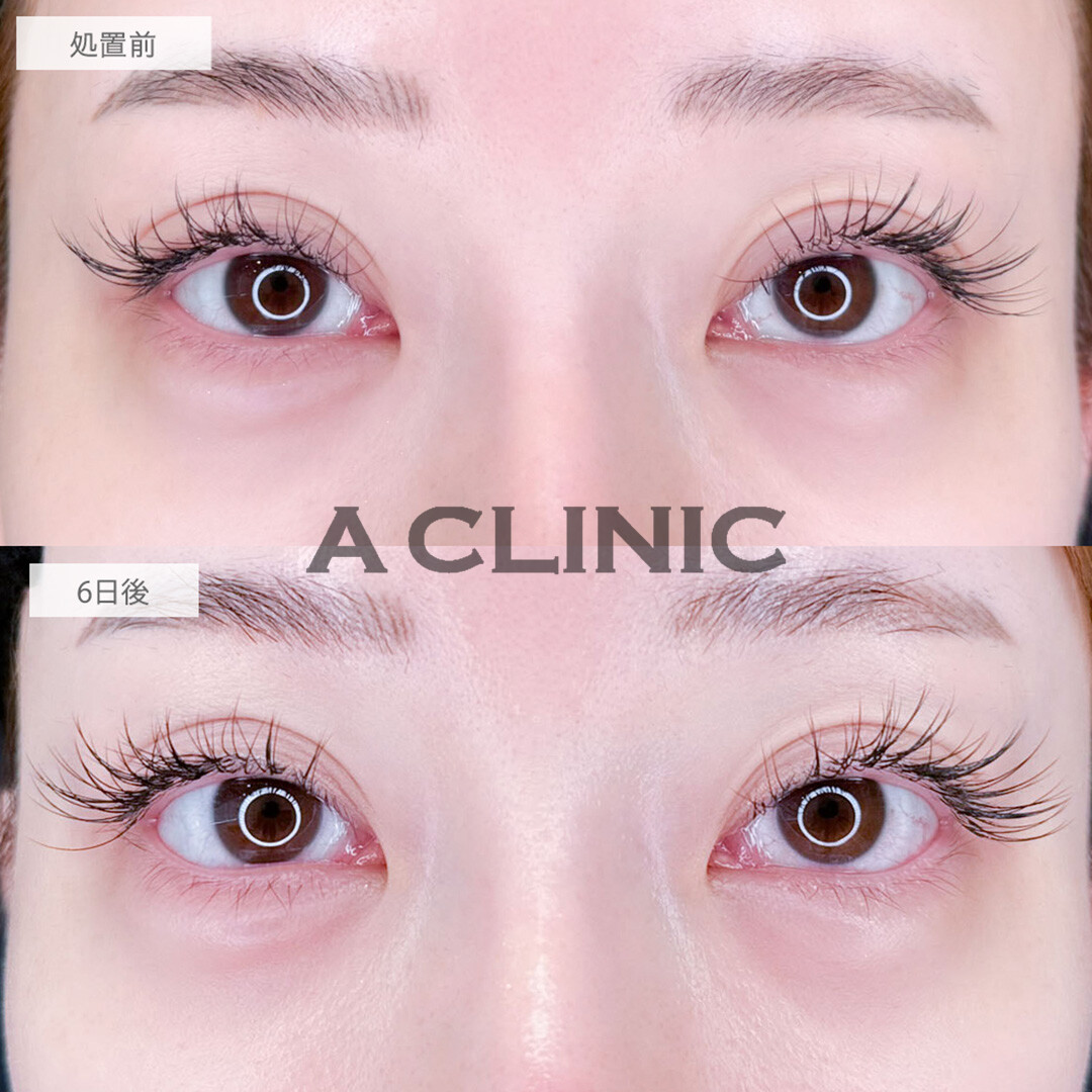 パーフェクトアイズで左右差が改善されより存在感のあるお目元に！処置前と6日後の症例です(30代女性)