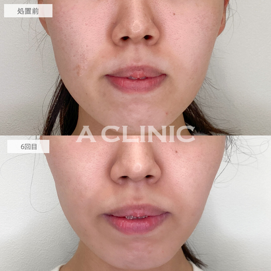 ポテンツァでニキビ跡と頑固なクレーターを撃退！処置前と6回目の症例です(20代女性)