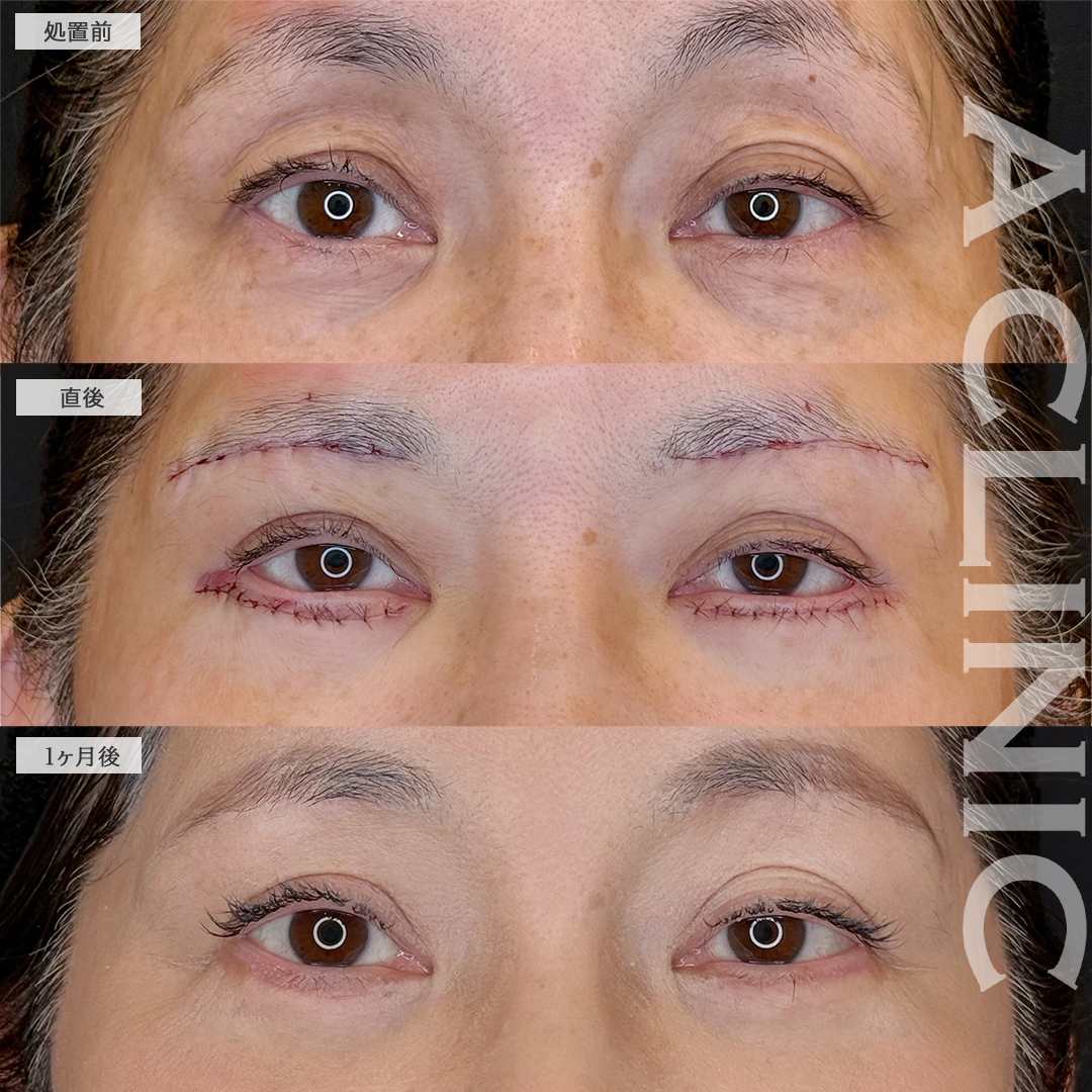 眉下リフトと目の下のたるみ取りで目元の年齢若返りました！こちら処置前と1ヶ月後の症例です(60代女性)
