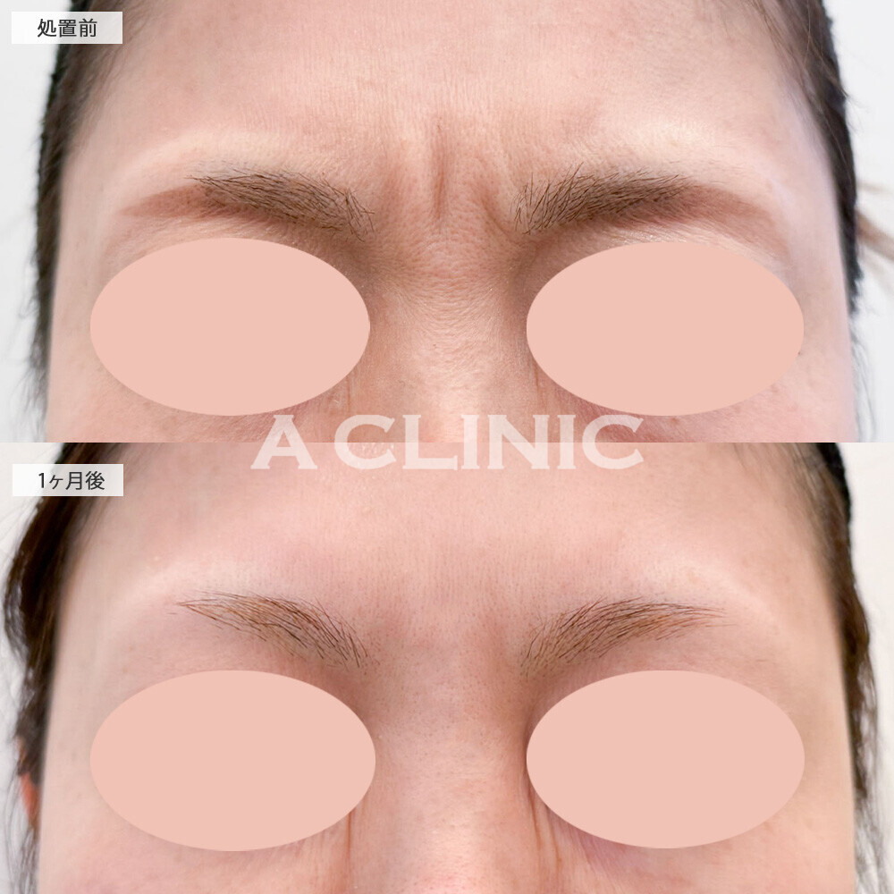 ボトックス注射(しわ)で目つきも改善！こちら処置前と1ヶ月後の症例です(40代女性)