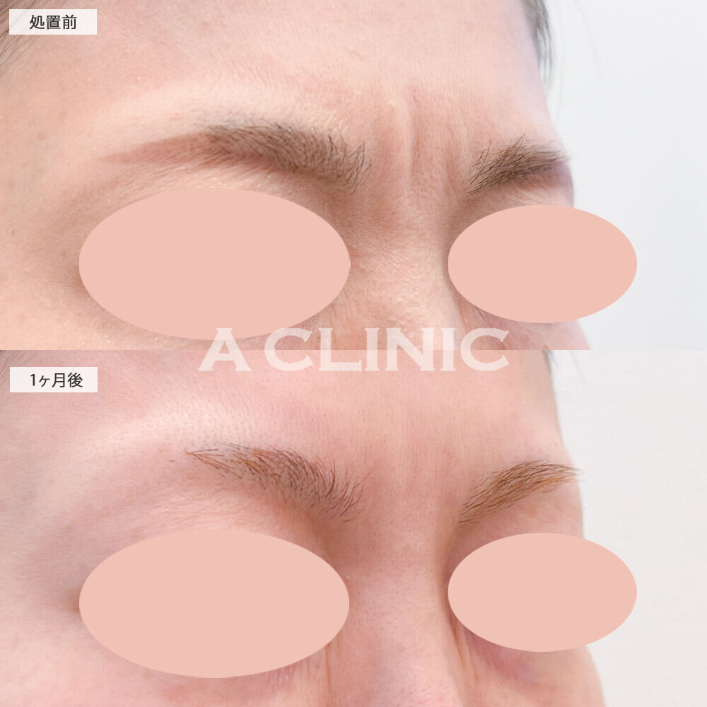 ボトックス注射(しわ)で目つきも改善！こちら処置前と1ヶ月後の症例です(40代女性)