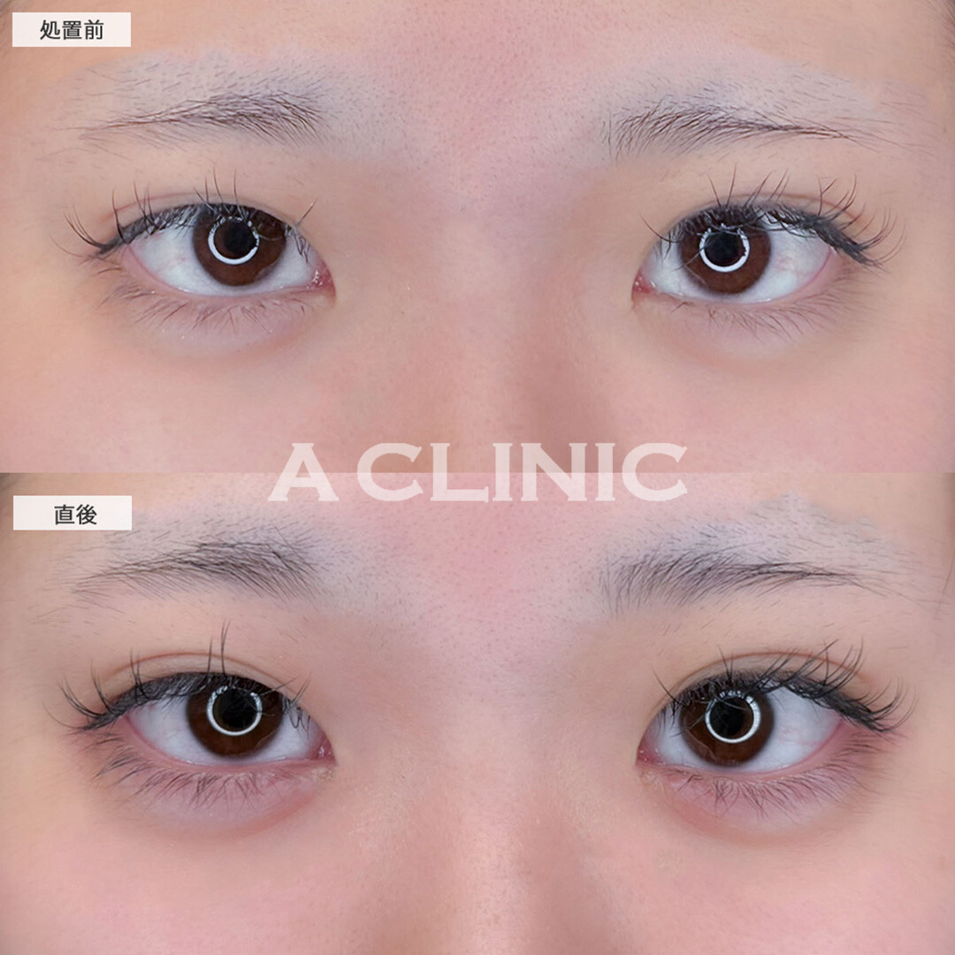 涙袋形成術(ヒアルロン酸)で涙袋がよりぷっくりと可愛い目元になりました！こちら処置前と直後の症例です(10代女性)