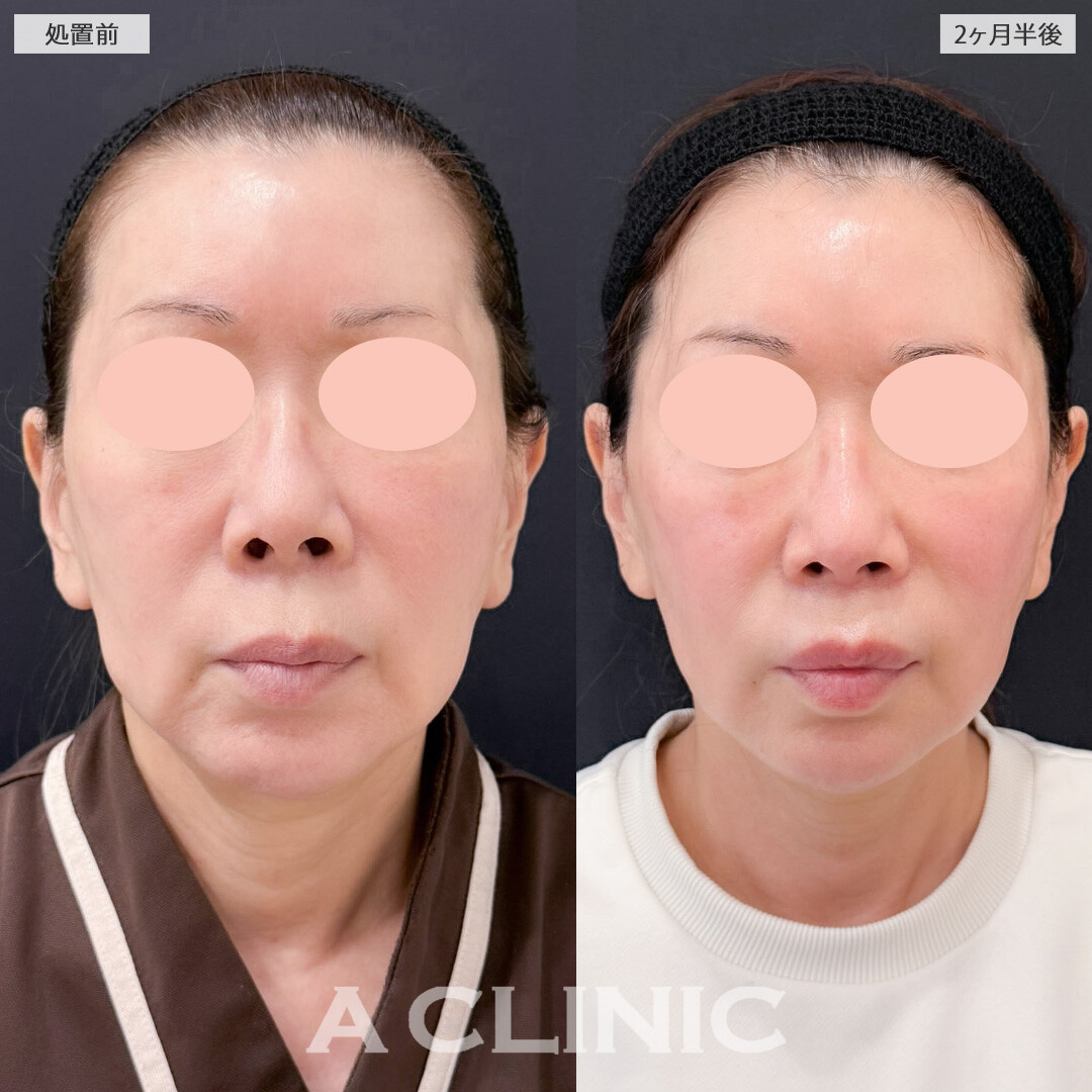 1day小顔脂肪吸引とバッカルファット除去術で年齢と共に下がってきた脂肪を撃退出来ました！こちら処置前と2か月半後の症例です(60代女性)