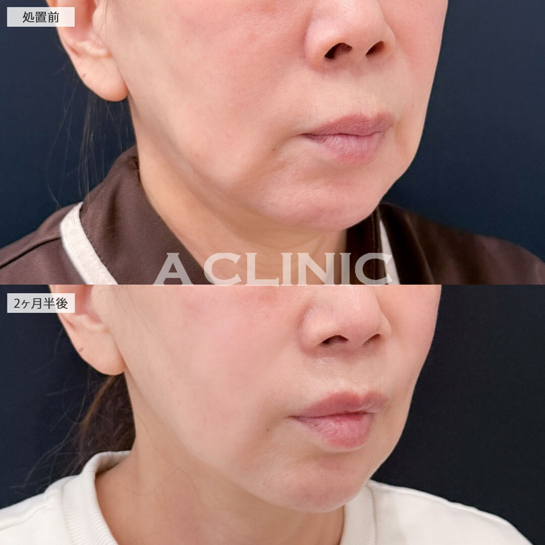 1day小顔脂肪吸引とバッカルファット除去術で年齢と共に下がってきた脂肪を撃退出来ました！こちら処置前と2か月半後の症例です(60代女性)