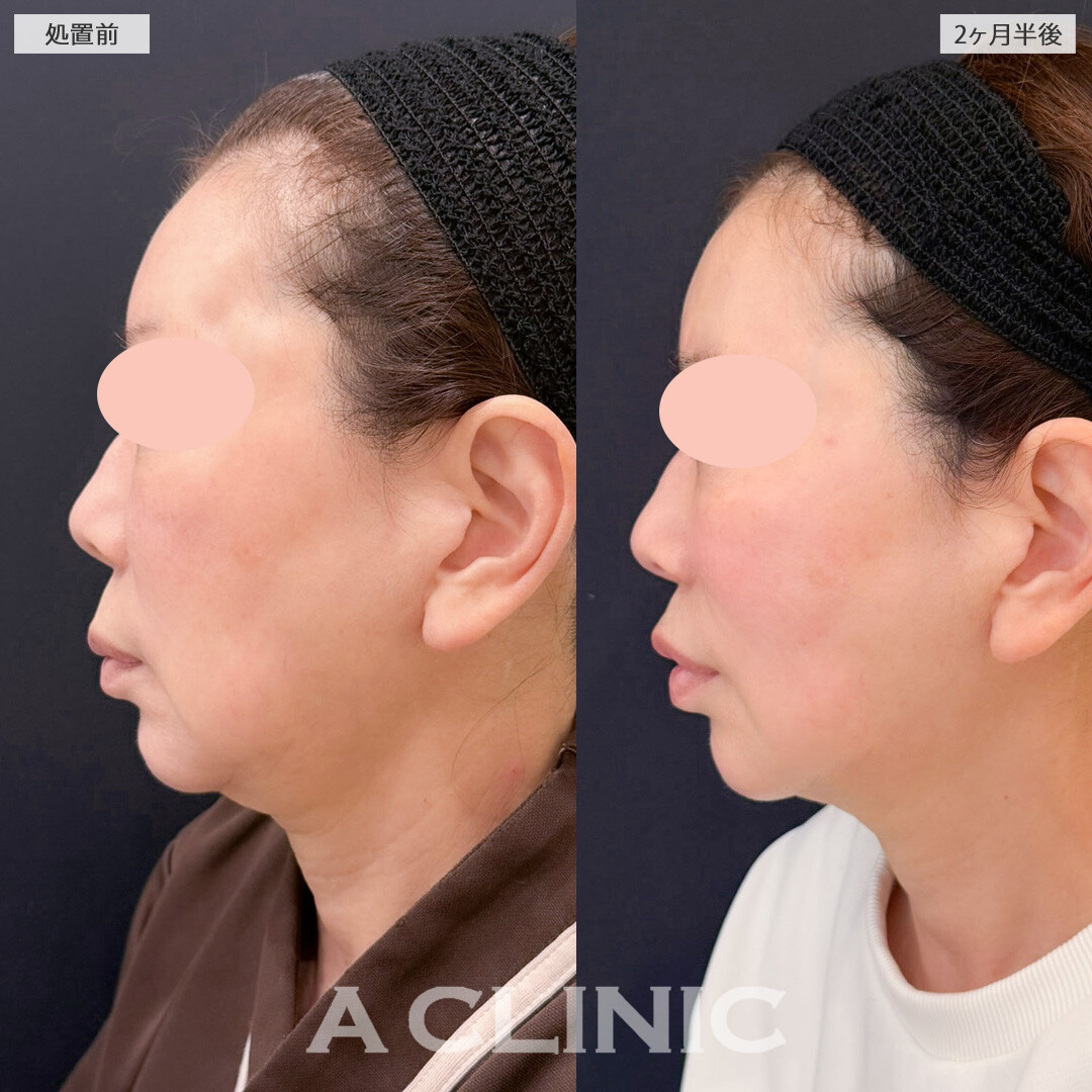 1day小顔脂肪吸引とバッカルファット除去術で年齢と共に下がってきた脂肪を撃退出来ました！こちら処置前と2か月半後の症例です(60代女性)