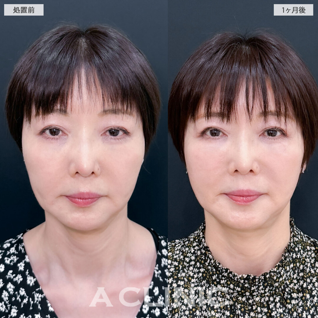 A式ナゾラリフトはほうれい線まわりのお悩みに特化した施術です！こちら処置前と1ヶ月後の症例です(60代女性)