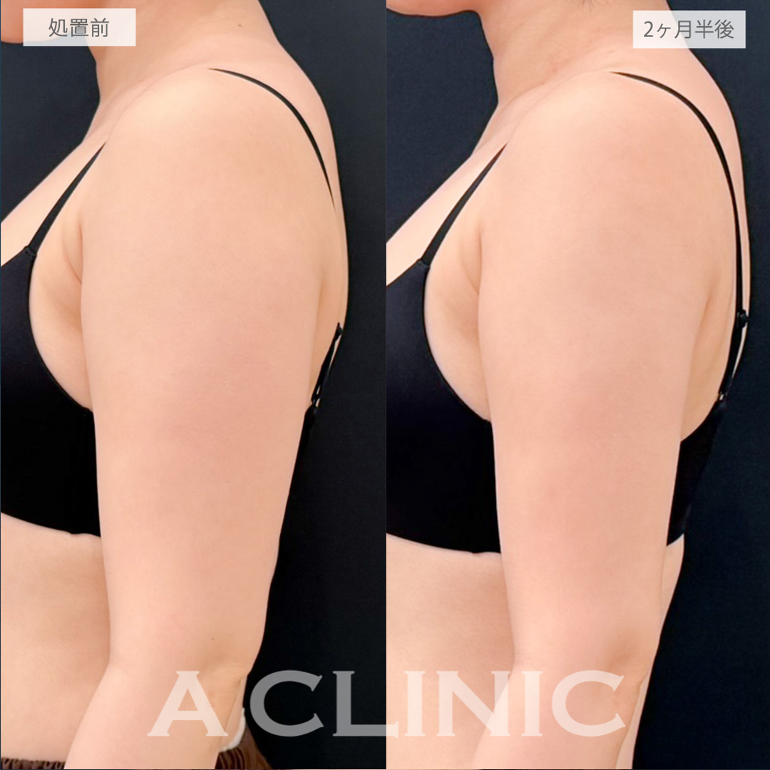 二の腕スリム脂肪吸引で脂肪の付きやすい上半身をスッキリさせてスタイルのバランスが良くなりました！処置前と2ヶ月半後の症例です(20代女性)