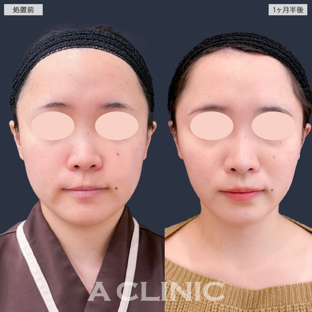 1day小顔脂肪吸引で痩せにくい顔を自然にアップデート！こちら処置前と1ヶ月半後の症例です(20代女性)