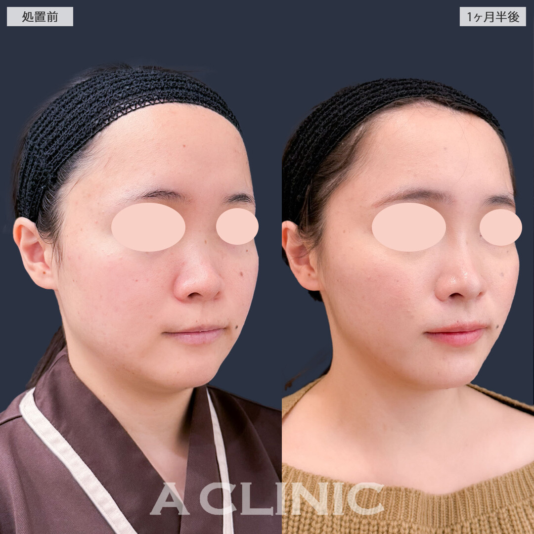 1day小顔脂肪吸引で痩せにくい顔を自然にアップデート！こちら処置前と1ヶ月半後の症例です(20代女性)