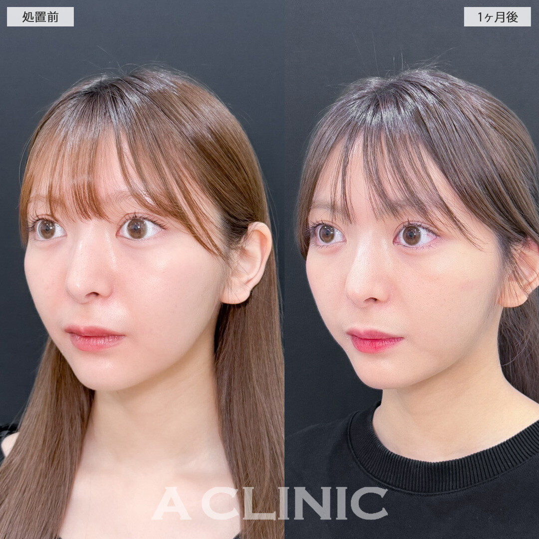 1day小顔脂肪吸引で元々小顔の方も輪郭整えアップデート！こちら処置前と1ヶ月後の症例です(20代女性)