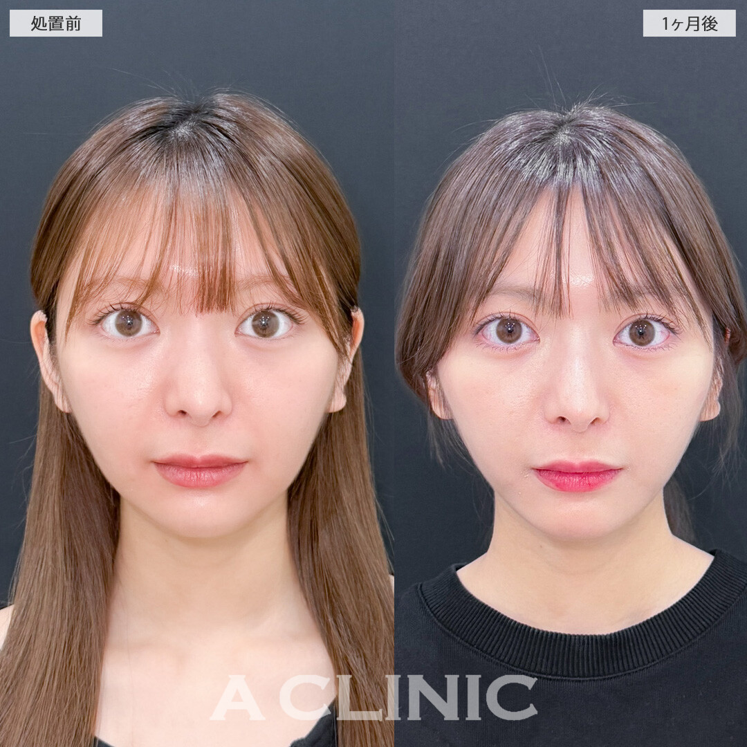 1day小顔脂肪吸引で元々小顔の方も輪郭整えアップデート！こちら処置前と1ヶ月後の症例です(20代女性)