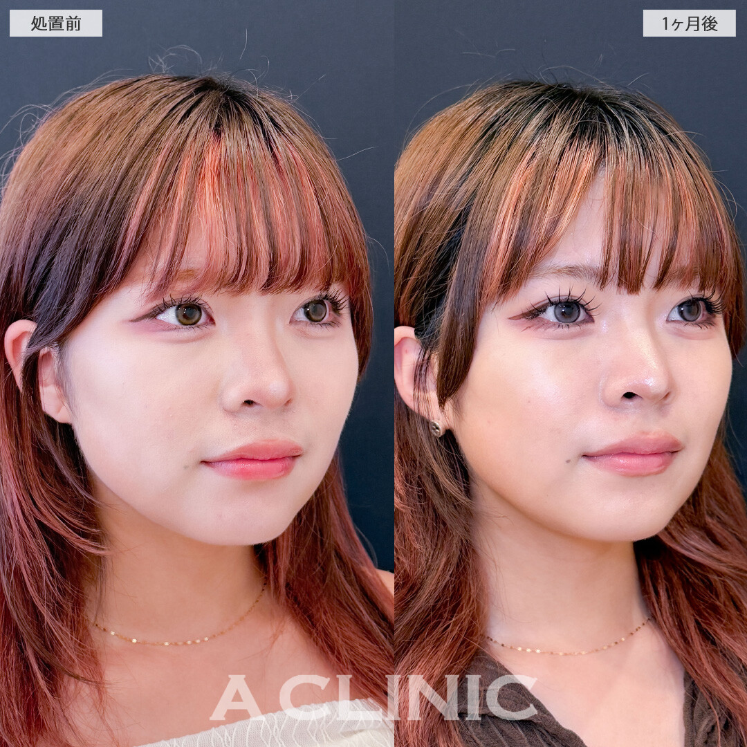 1day小顔脂肪吸引で丸顔っぽさを自然に解消！こちら処置前と1ヶ月後の症例です(20代女性)