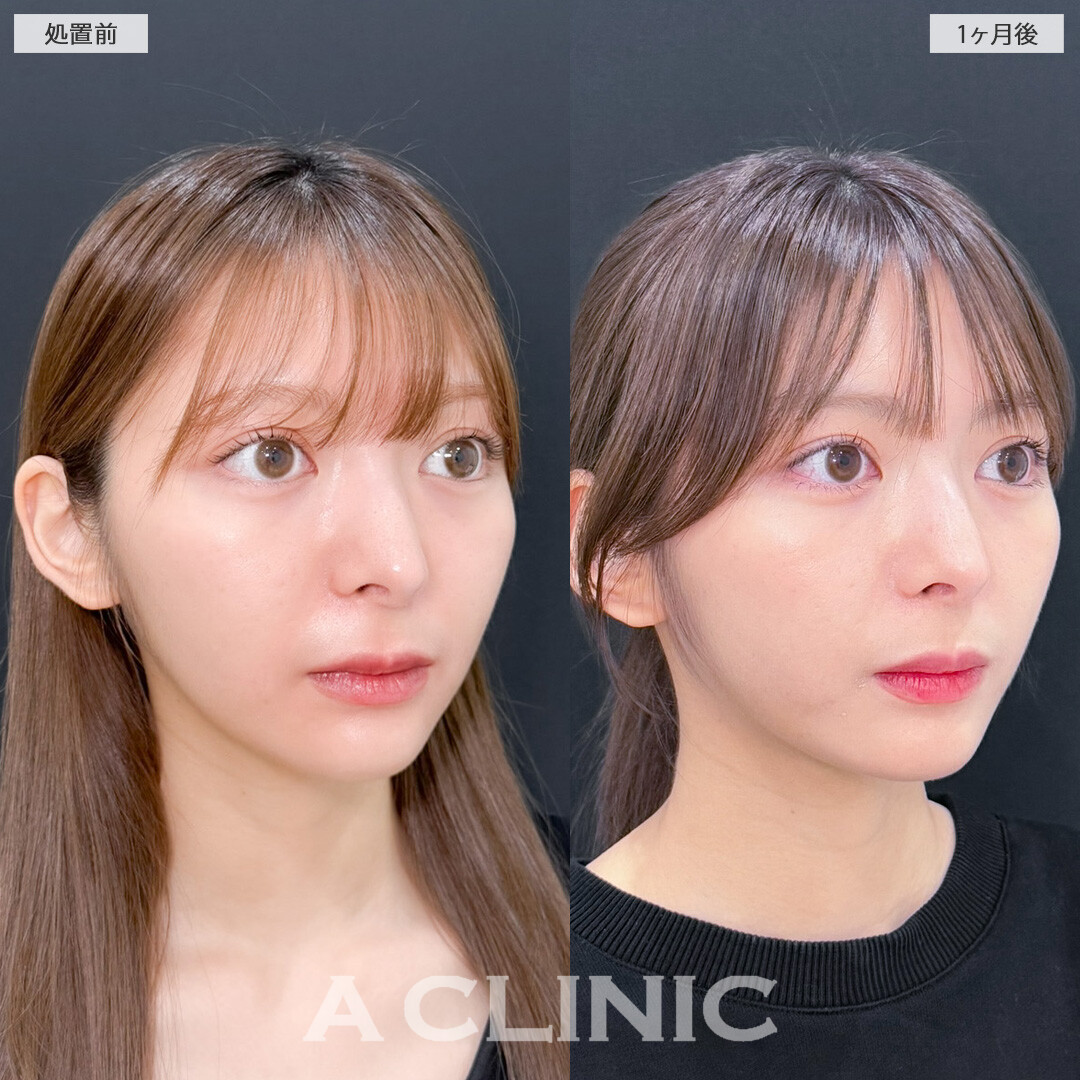 1day小顔脂肪吸引で元々小顔の方も輪郭整えアップデート！こちら処置前と1ヶ月後の症例です(20代女性)