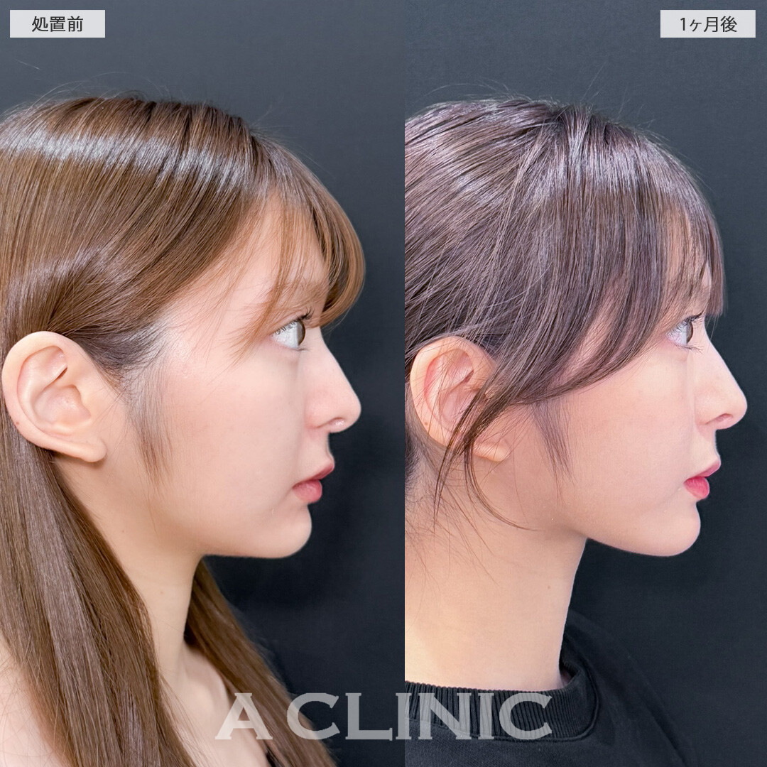 1day小顔脂肪吸引で元々小顔の方も輪郭整えアップデート！こちら処置前と1ヶ月後の症例です(20代女性)
