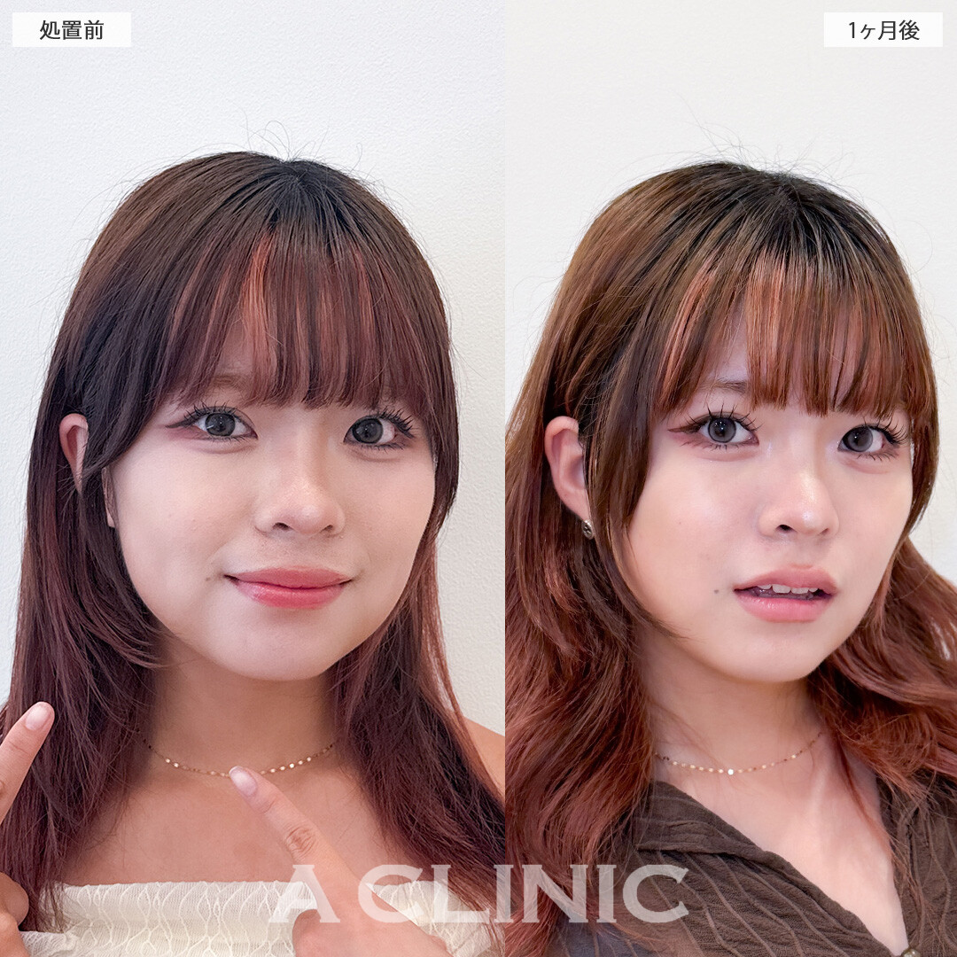 1day小顔脂肪吸引で丸顔っぽさを自然に解消！こちら処置前と1ヶ月後の症例です(20代女性)